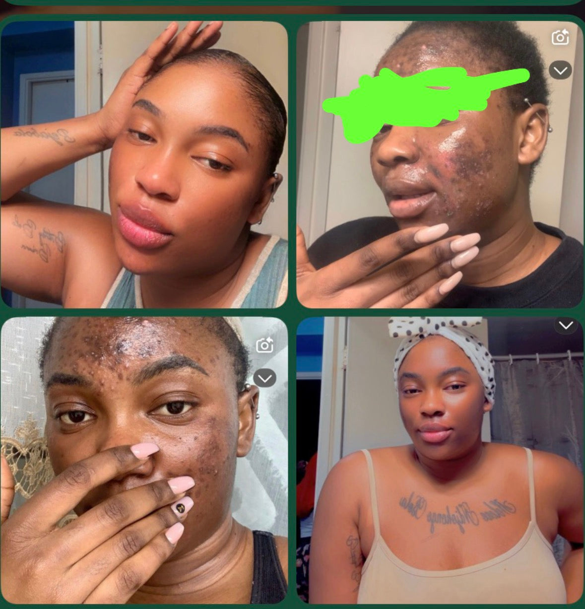 Acne face combo