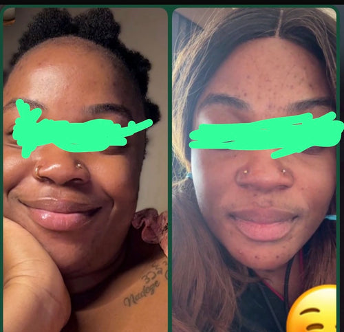 Acne face combo